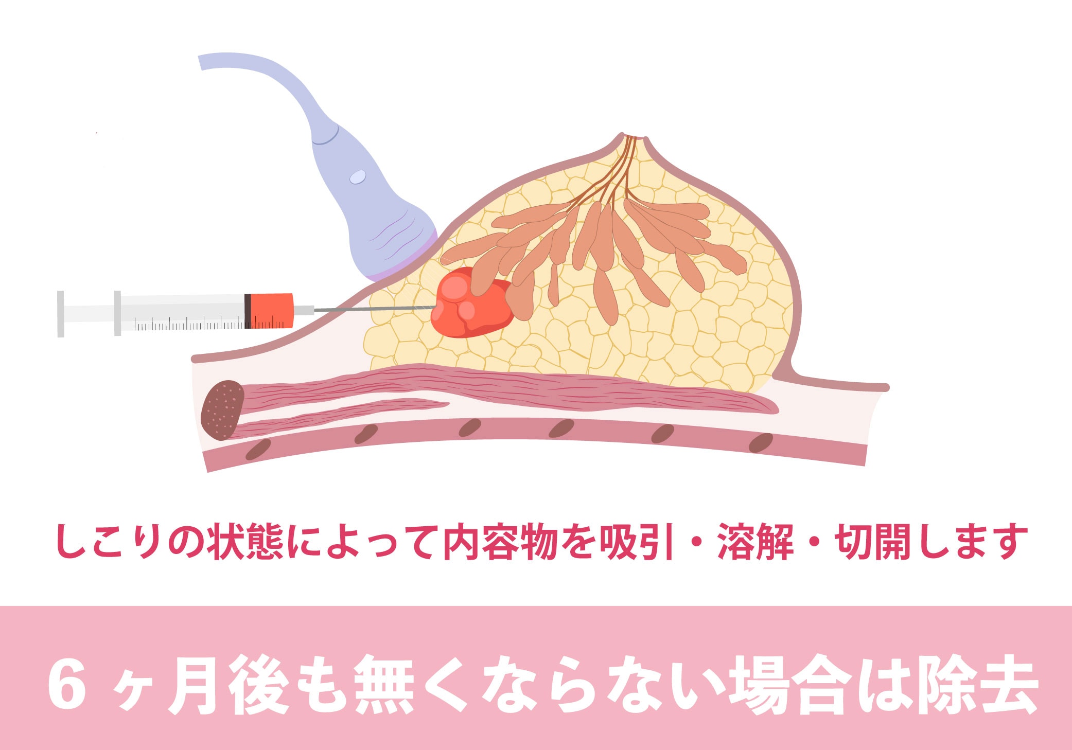 ６ヶ月〜1年経ってもしこりがなくならない場合