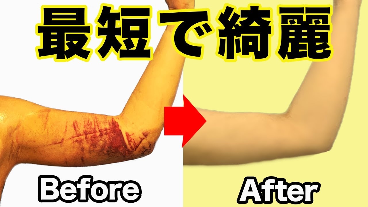 二の腕脂肪吸引のダウンタイムの症状を早く治すための方法3選！