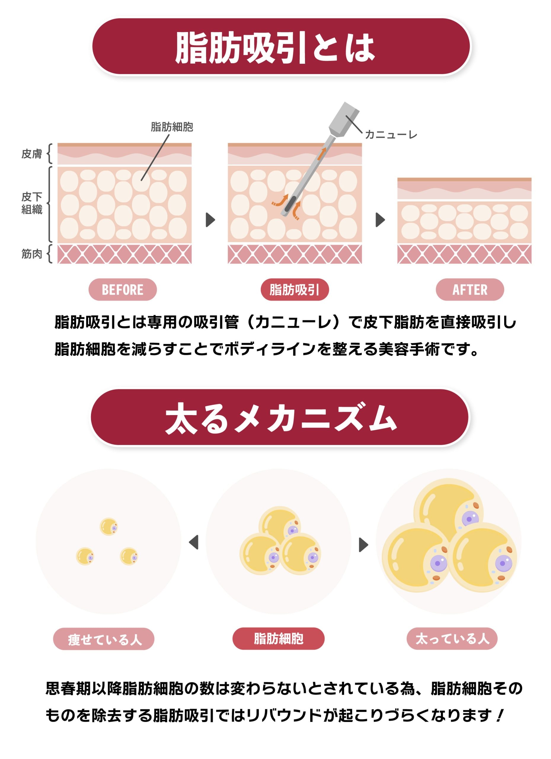 脂肪吸引とは