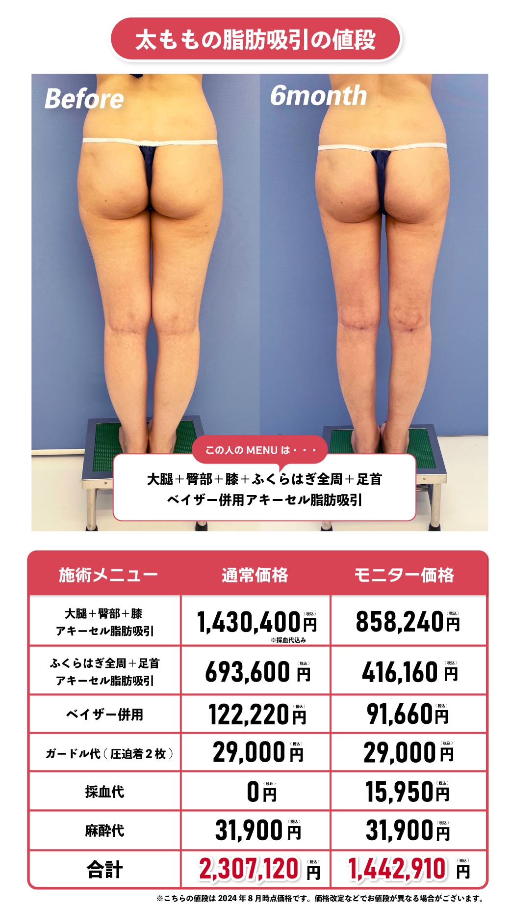 葛島先生の太ももの症例で見る脂肪吸引の値段