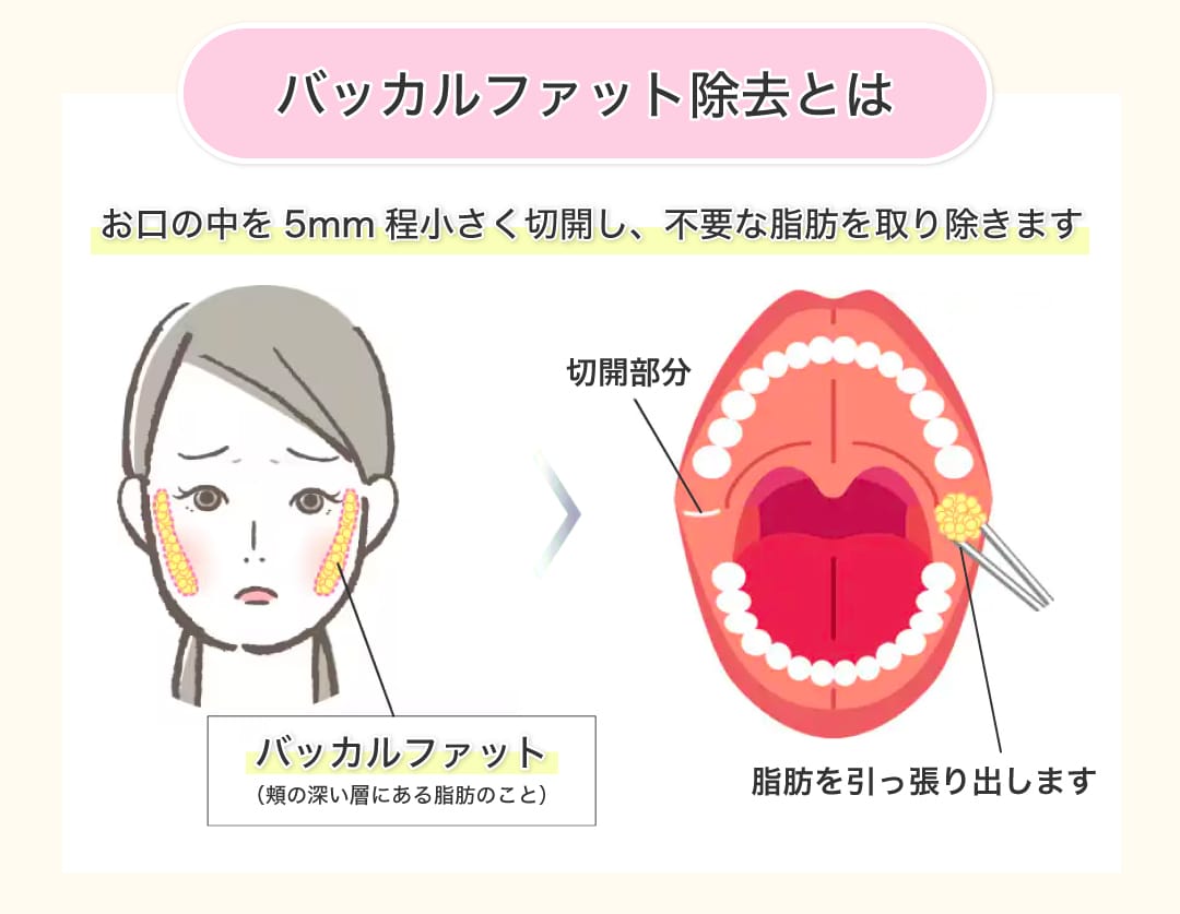 バッカルファット除去とは