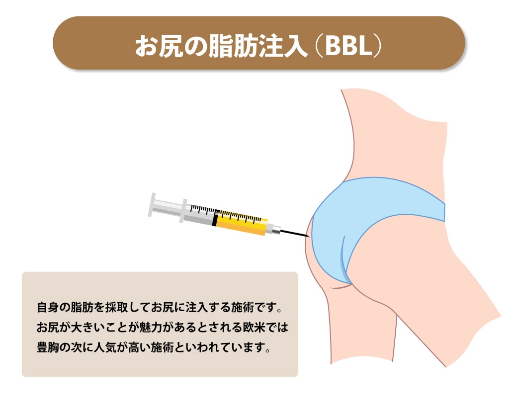 ブラジリアンバッドリフトとは