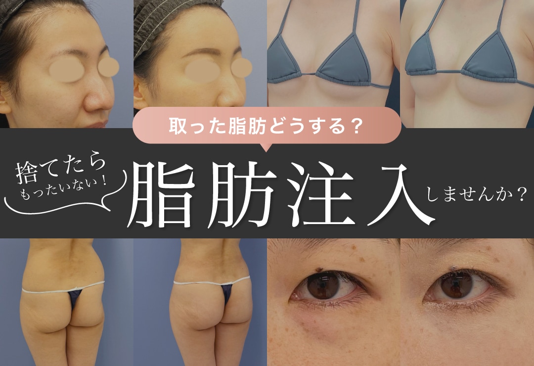 脂肪吸引したら脂肪注入！自身の細胞を使って若返り！？脂肪注入で出来る事とは？