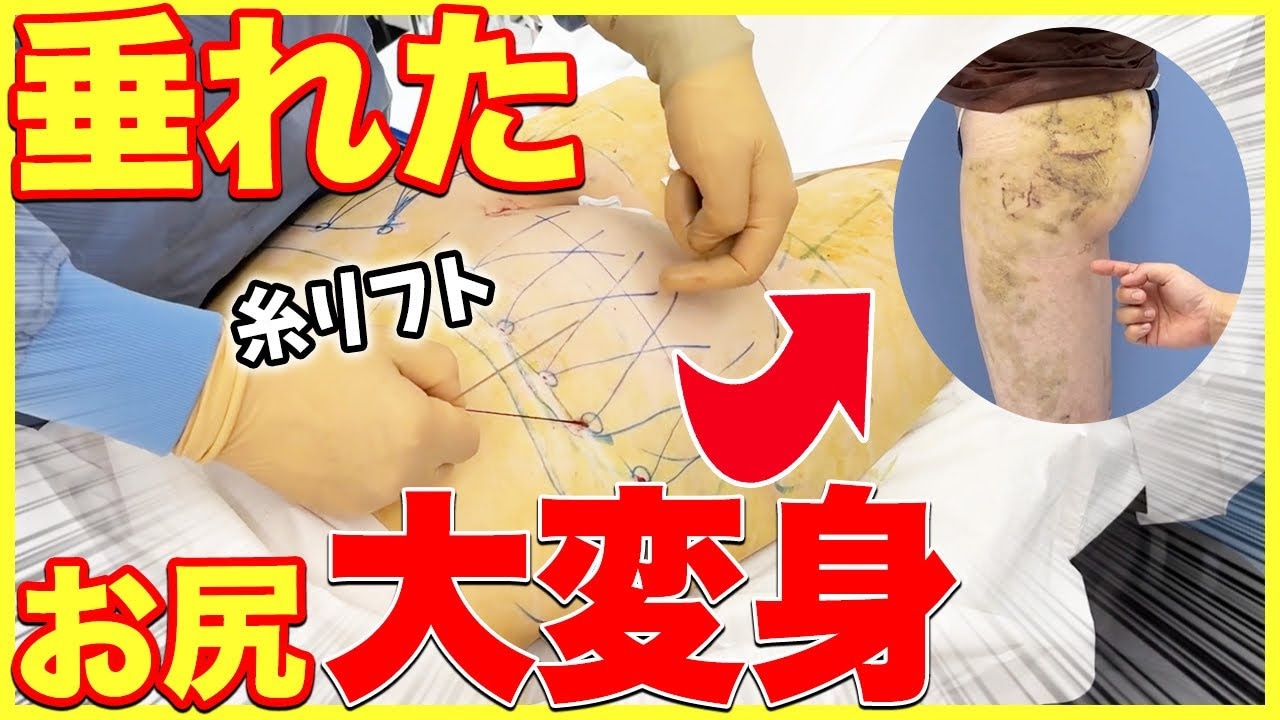 脂肪吸引の修正手術で顔やお尻はどうなった？術後3日目の経過を紹介！