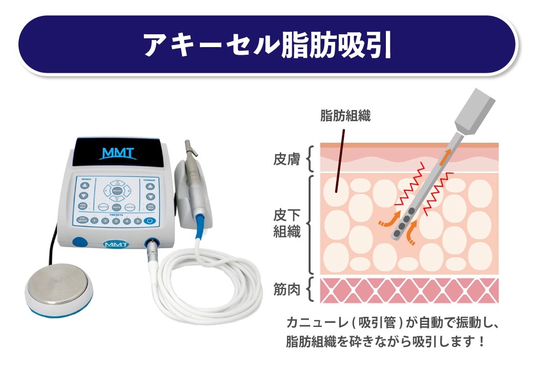 アキーセル脂肪吸引