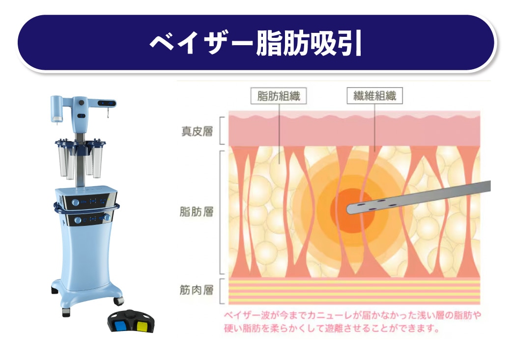 ベイザー脂肪吸引