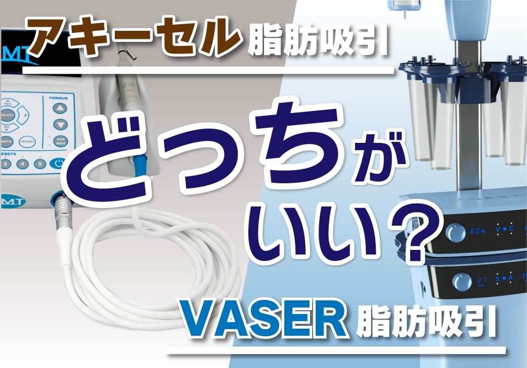 脂肪吸引の機械はベイザーとアキーセルどっちがいい？ 人気の２機種ベイザー脂肪吸引とアキーセル脂肪吸引の違いについて