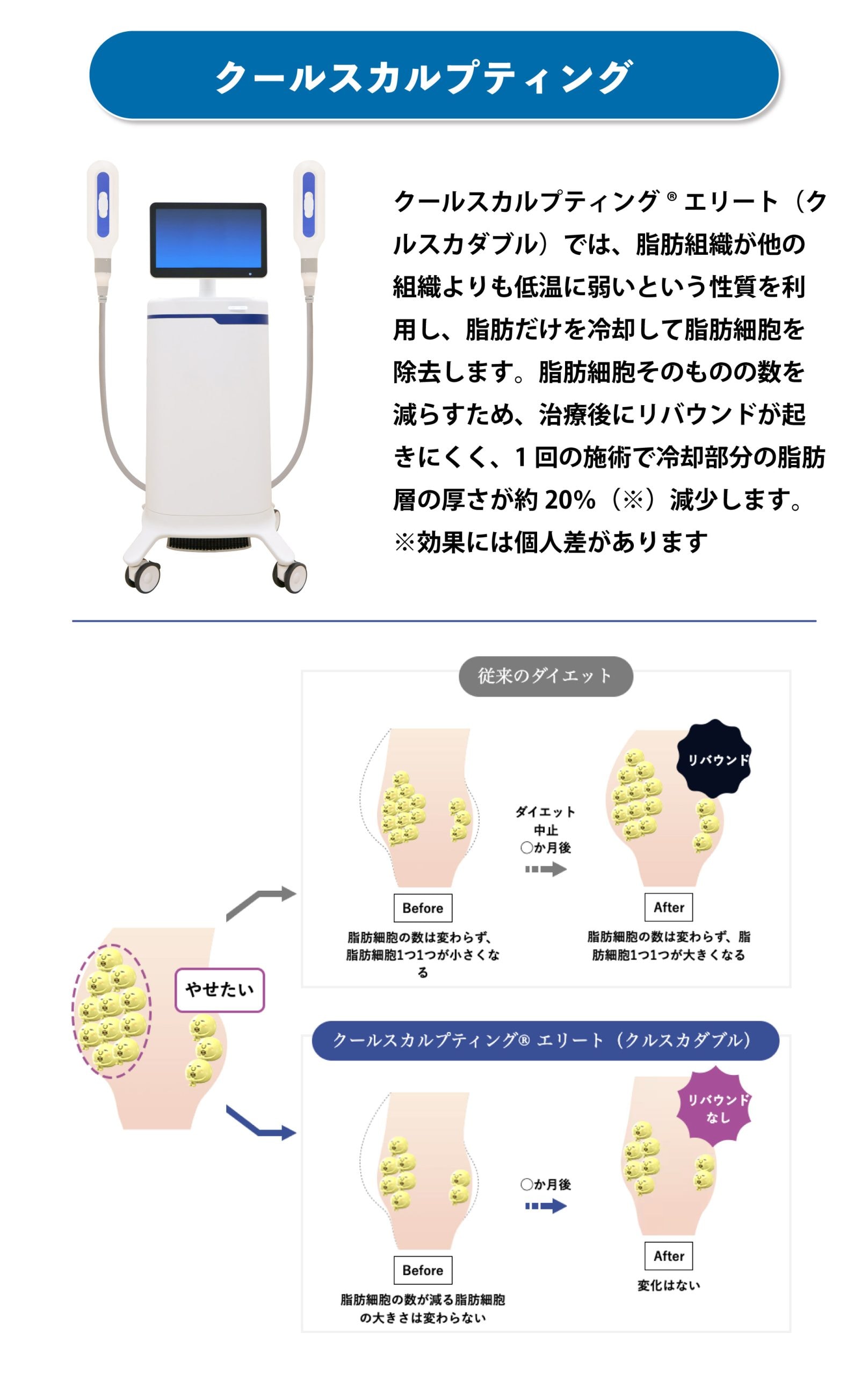 クールスカルプティング（CoolSculpting）について