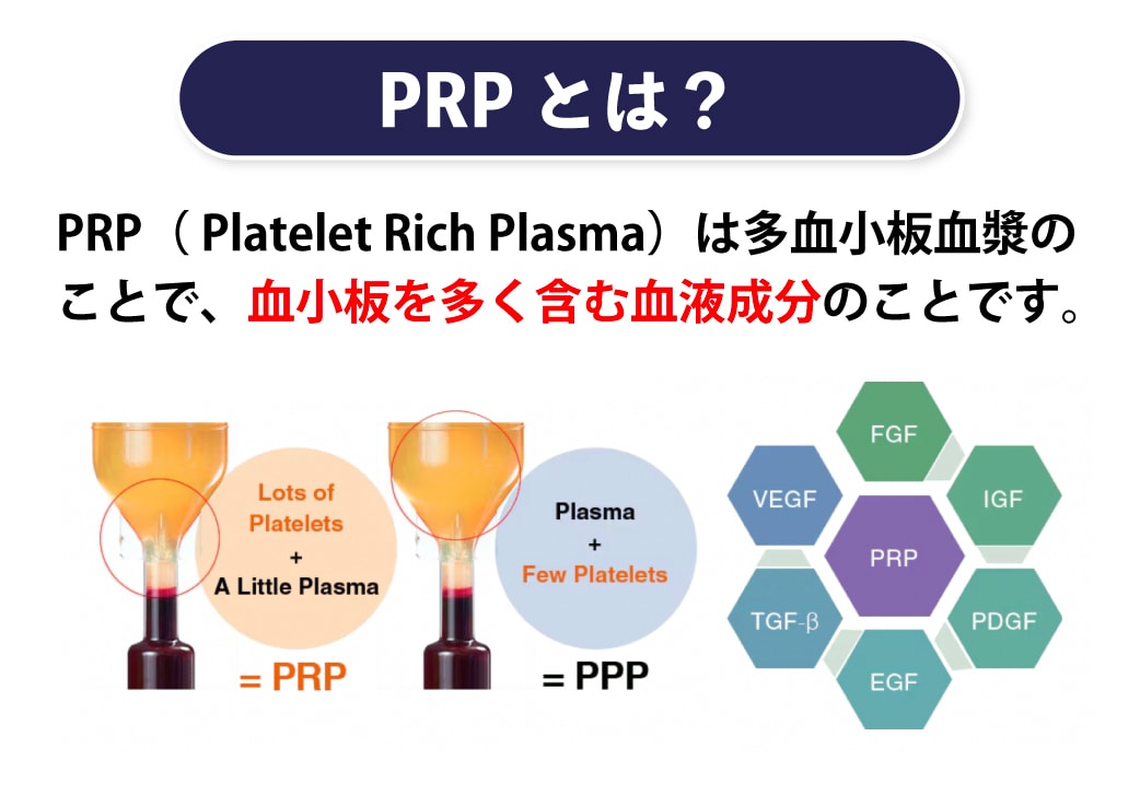 美容クリニックで行われるPRP皮膚再生治療はこんな治療