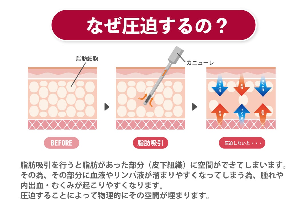 どうして圧迫が必要なの？