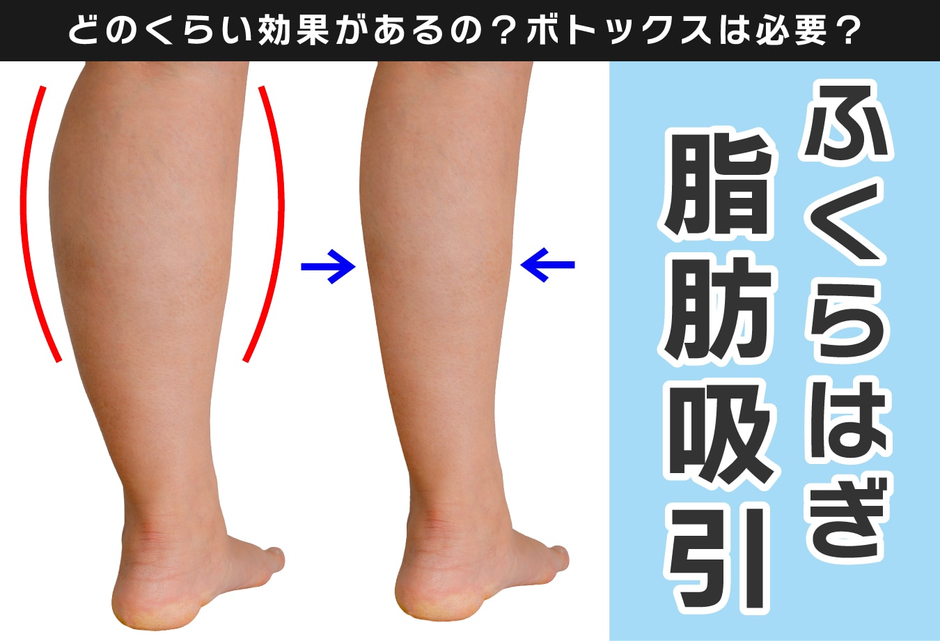 ふくらはぎの脂肪吸引の効果って？ボトックスの併用についても解説します！