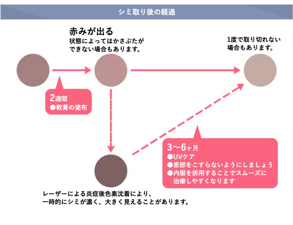 シミ取りレーザー