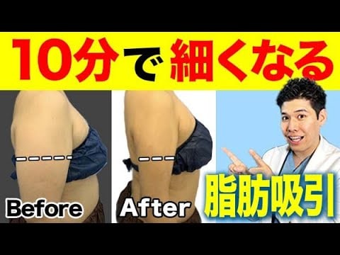 ベイザー脂肪吸引を徹底解説！ダウンタイムを抑えて二の腕痩せしたい方へ