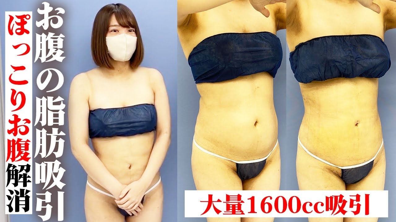 お腹の脂肪吸引の拘縮はどのくらい硬くて痛い？施術を受けた女性に密着！