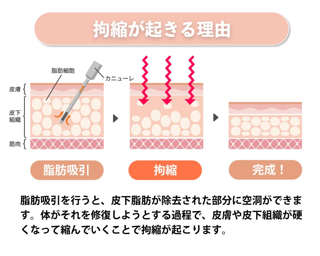 拘縮はどうして起きるの？