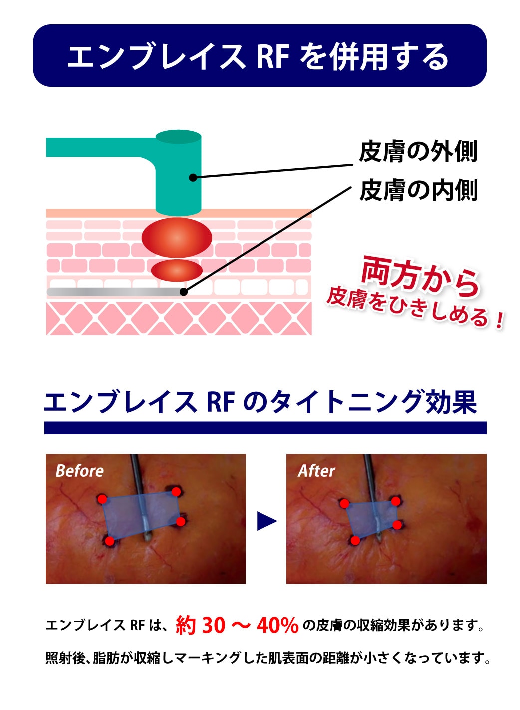 エンブレイスRFなどのタイトニング治療を併用する