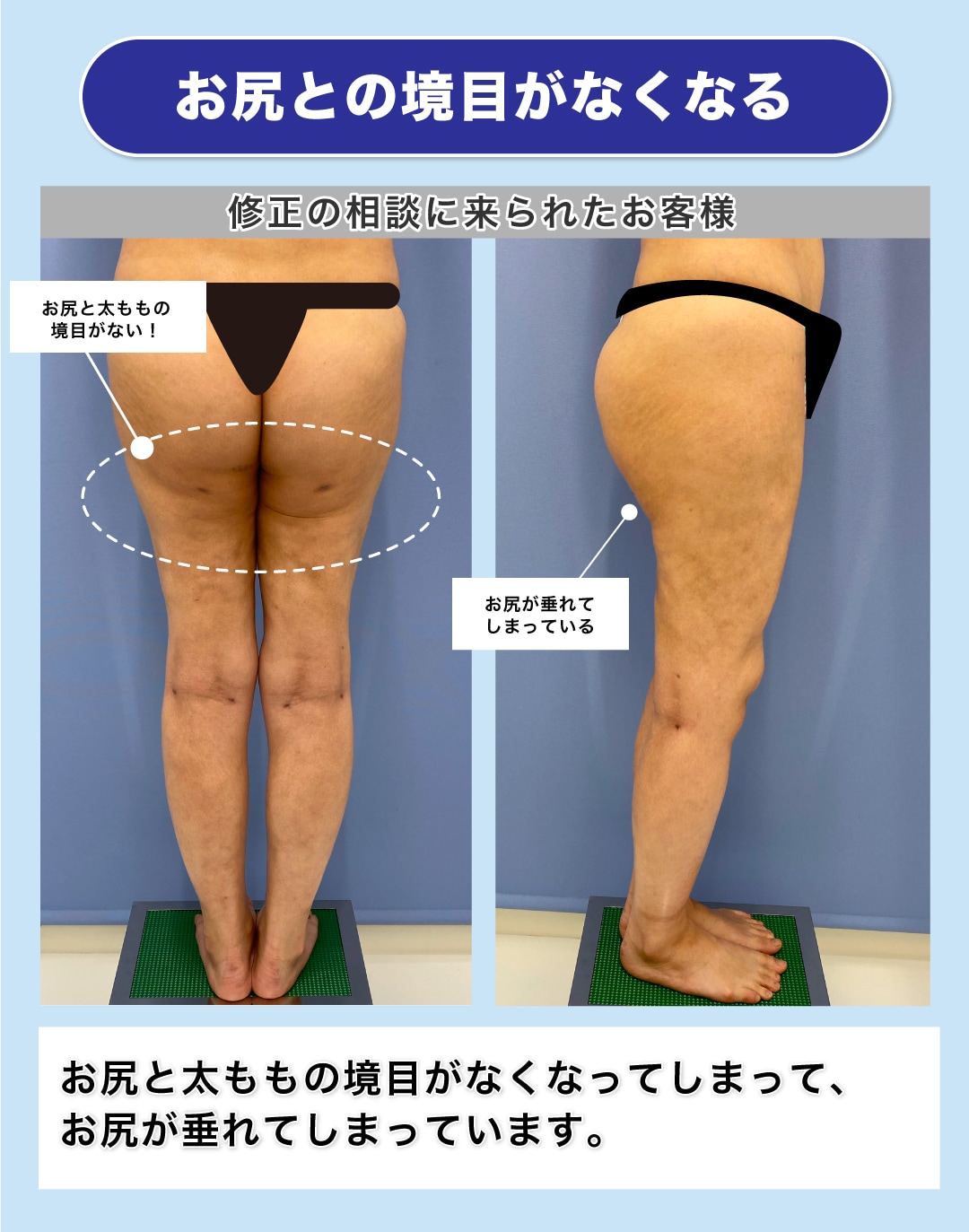 お尻との境目が無くなり、お尻が垂れてしまう