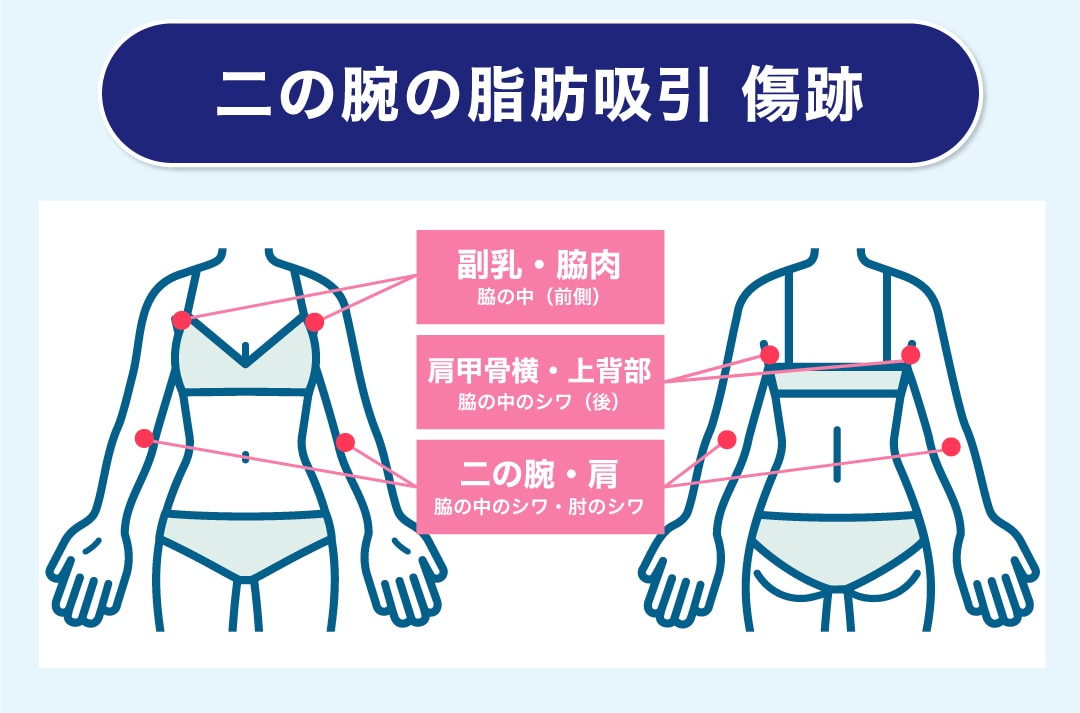 二の腕の傷跡の位置