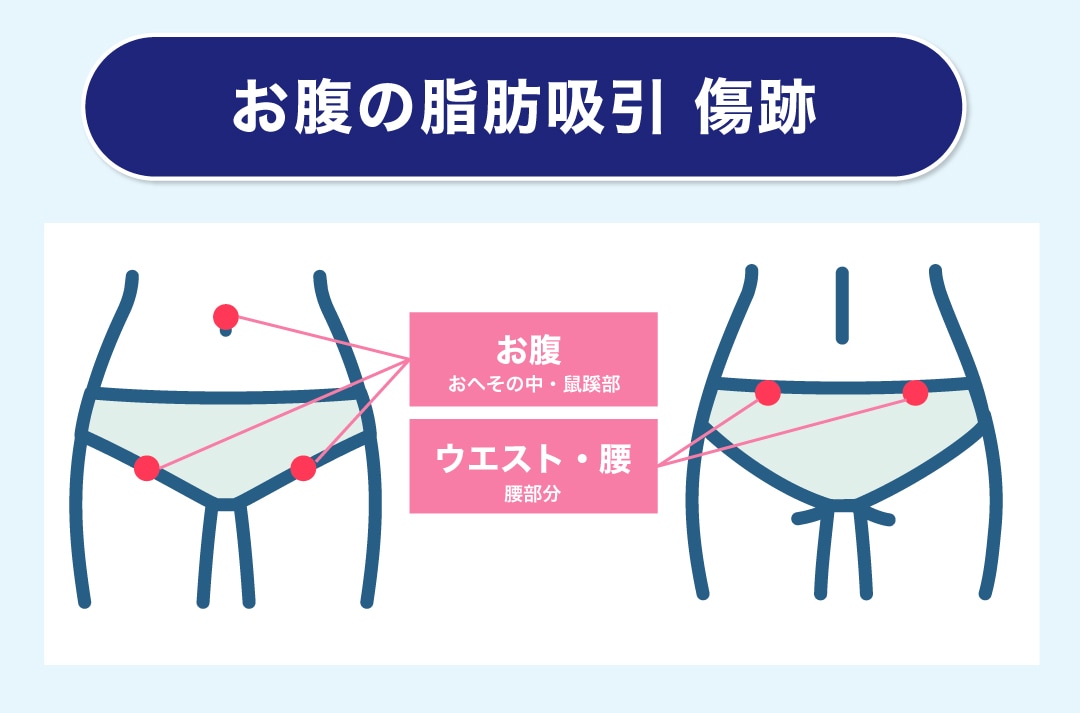 お腹の傷跡の位置