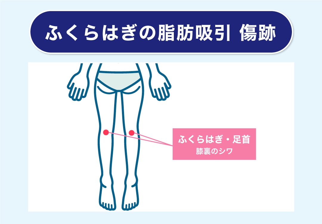 ふくらはぎの傷跡の位置