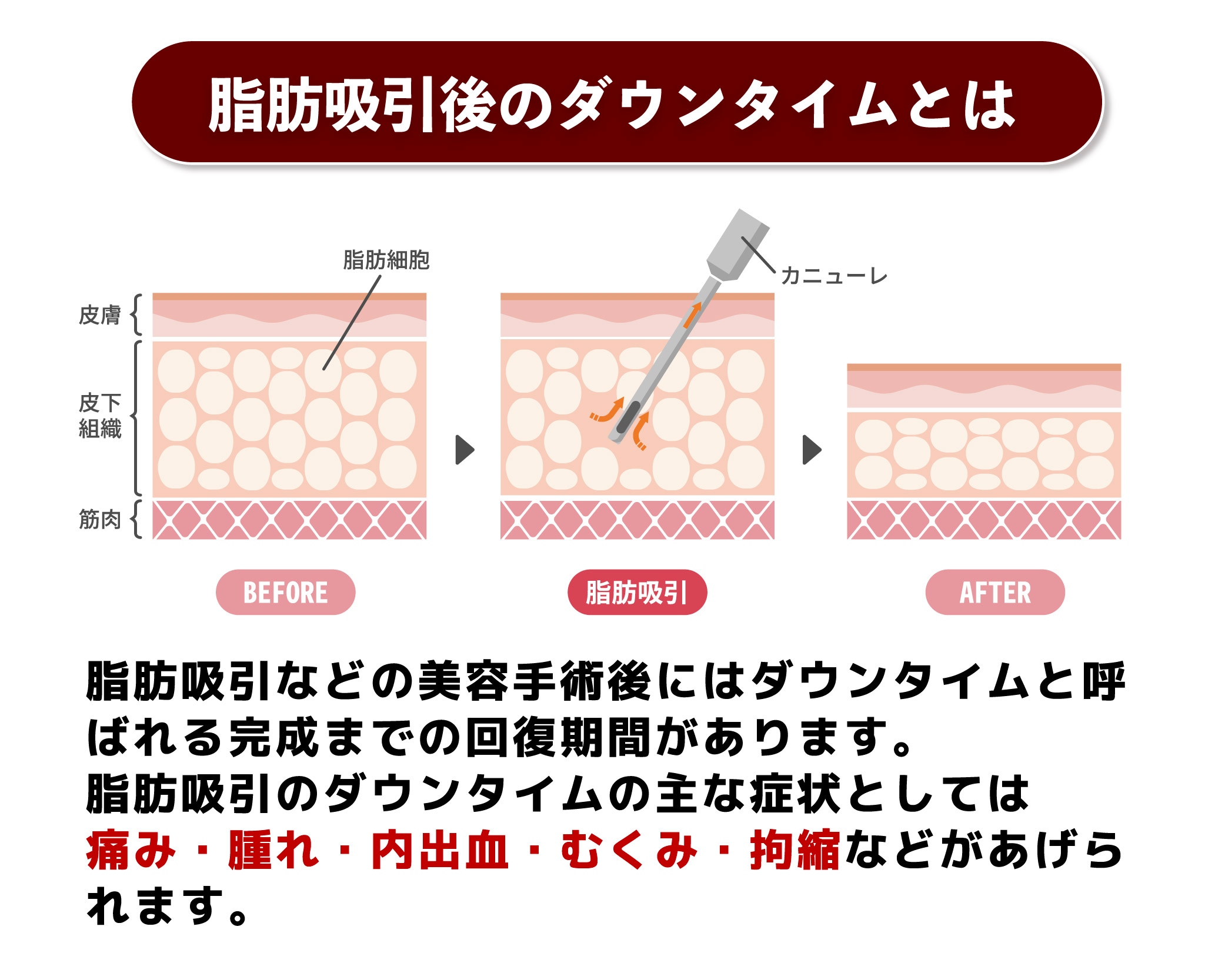 脂肪吸引のダウンタイムの主な症状