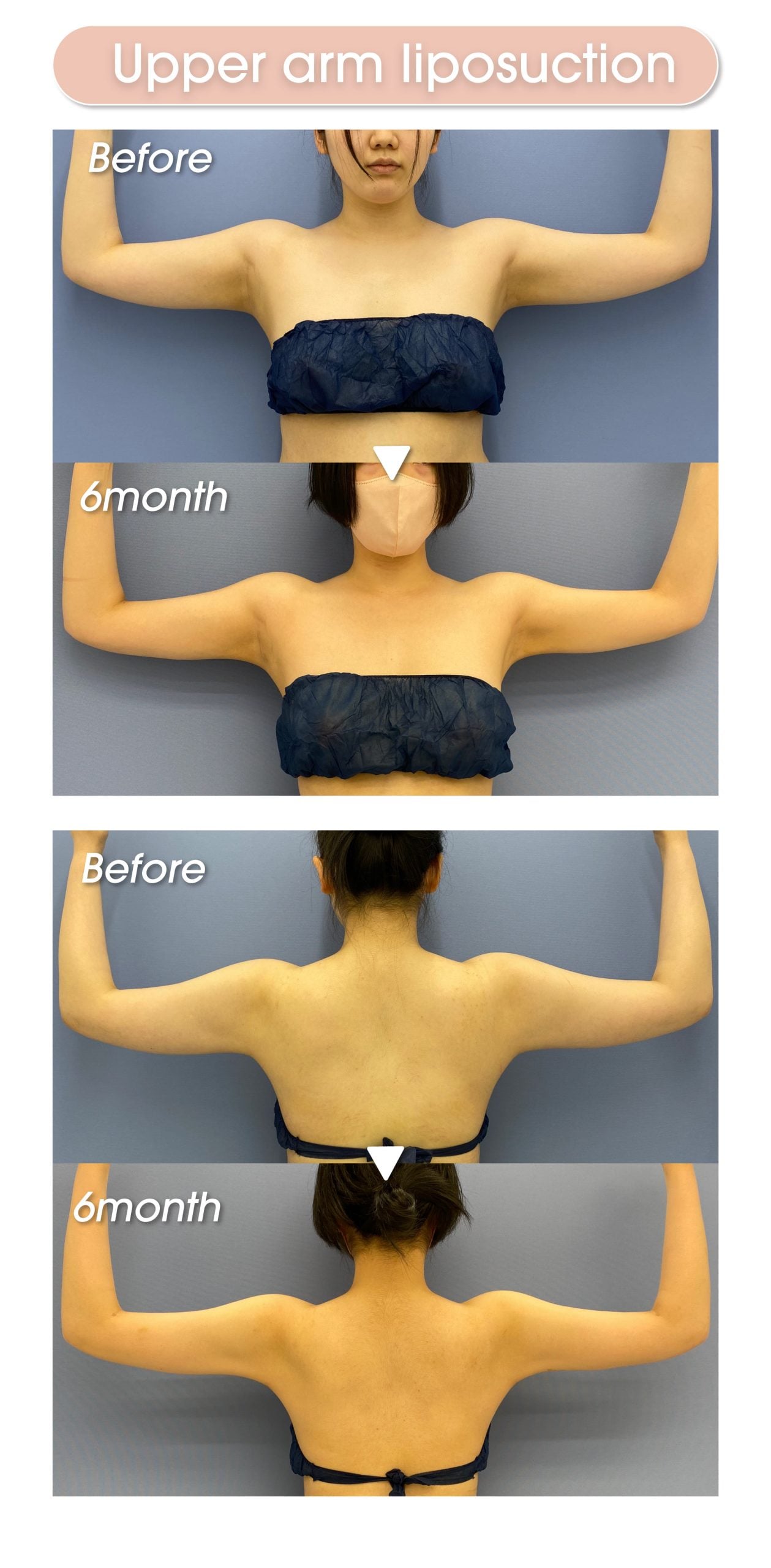 Upper arm liposuction