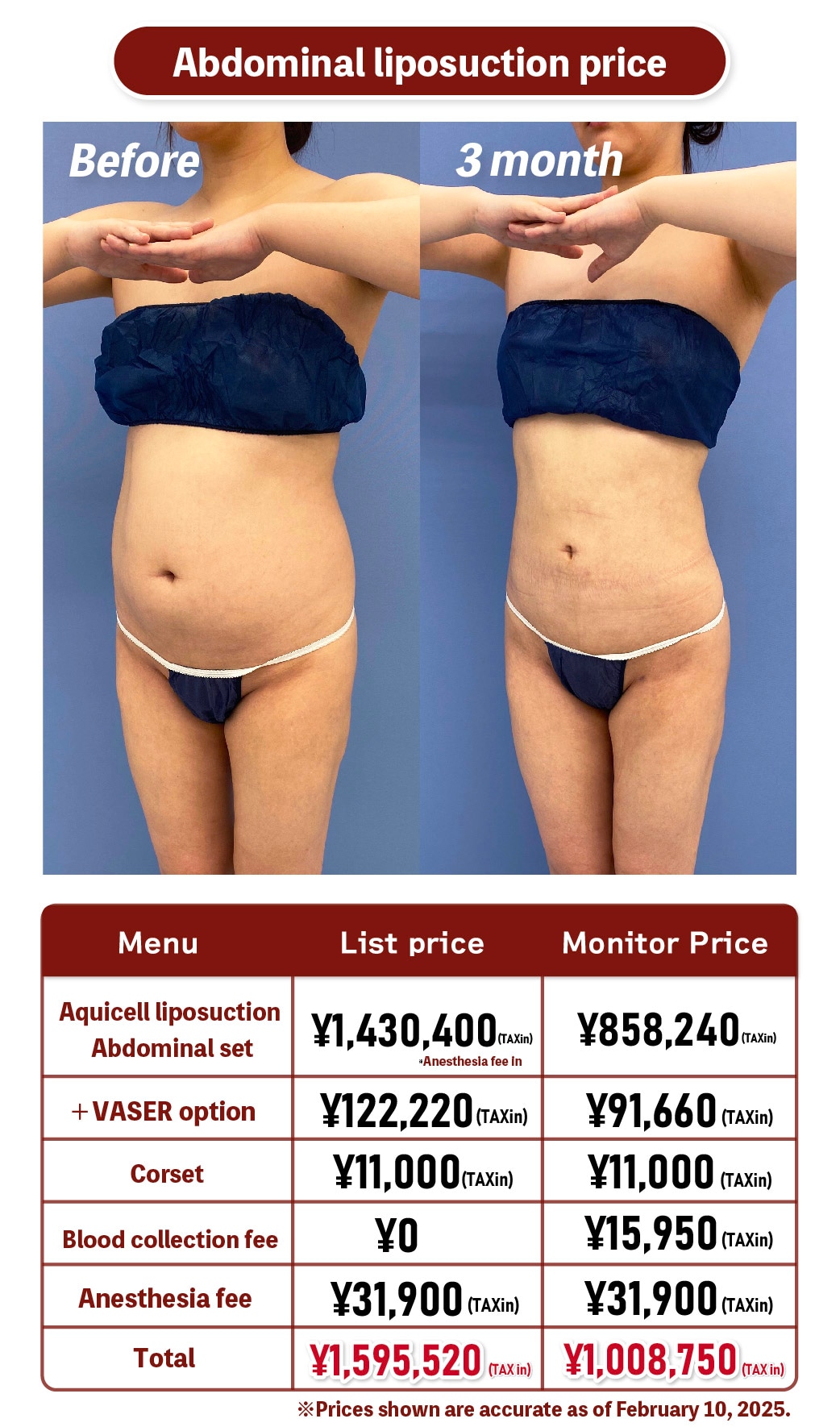 Abdominal liposuction