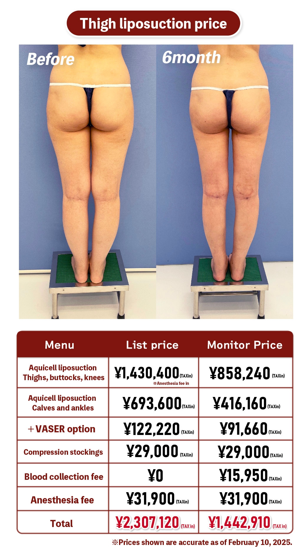 Thigh liposuction