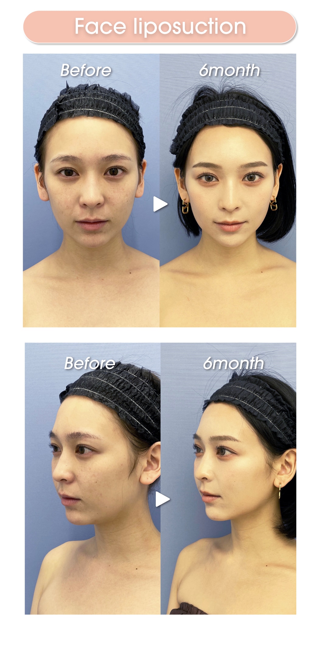 Face liposuction before and after