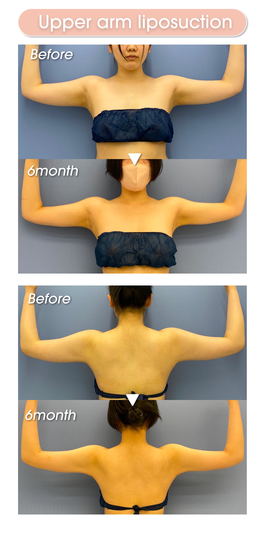 Upper arm liposuction before and after