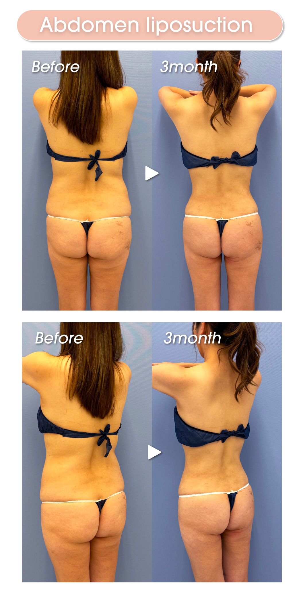 Stomach liposuction before and after