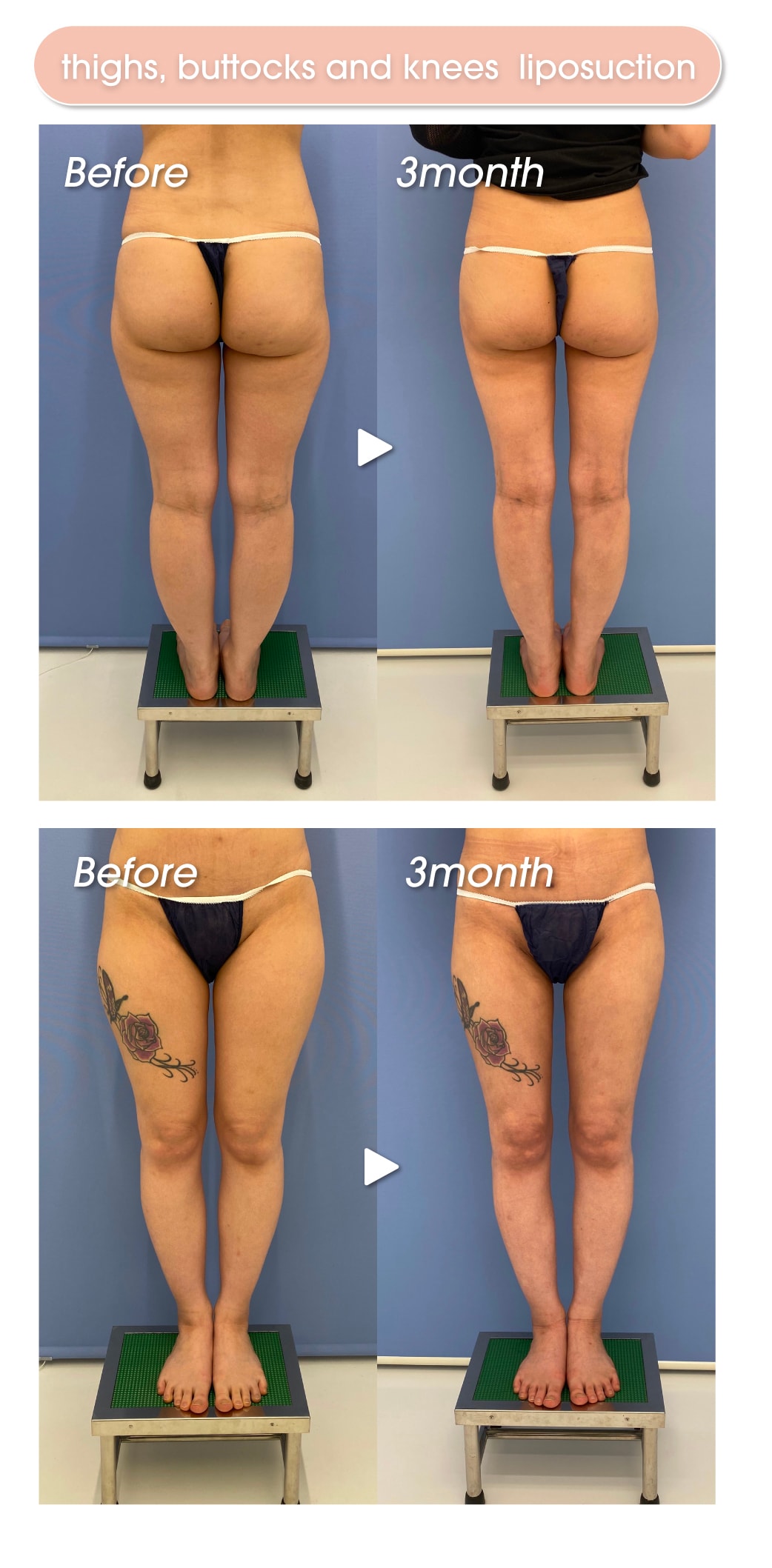 Thighs and buttocks liposuction before and after