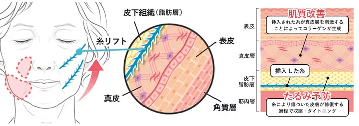 糸リフトってただ引き上げるだけじゃない！