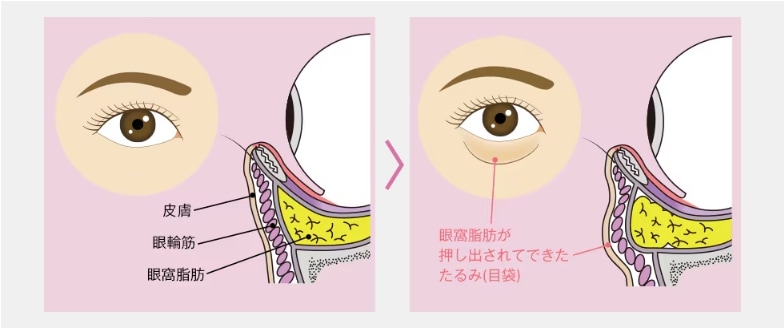 目の下にたるみとシワができる原因