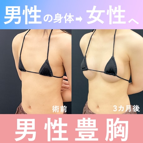 【男性豊胸】MtF向け豊胸｜おすすめの施術は？症例写真も公開中！