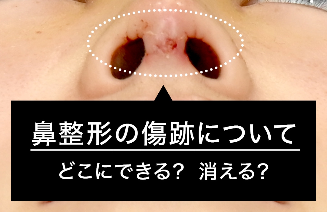 【鼻整形の傷跡】はどこにできる？どのくらい残る？