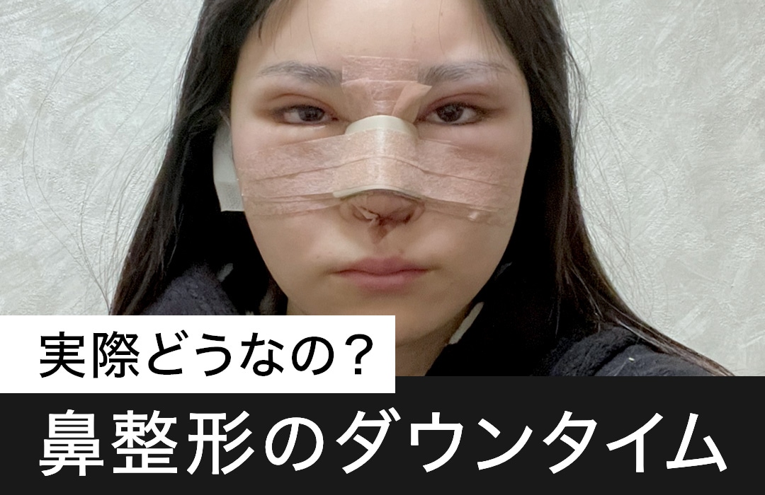 【鼻整形のダウンタム】はどのくらい？術後の経過を写真でチェック！湘南美容クリニック原宿院(東京・渋谷)