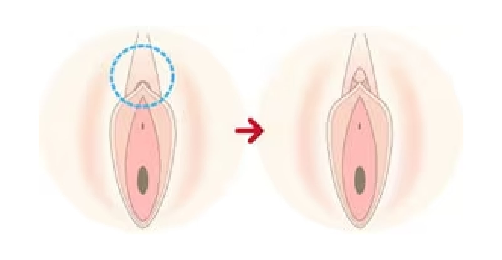 【陰核包茎術】不感症や、性交渉時の痛みにお悩みの方へ