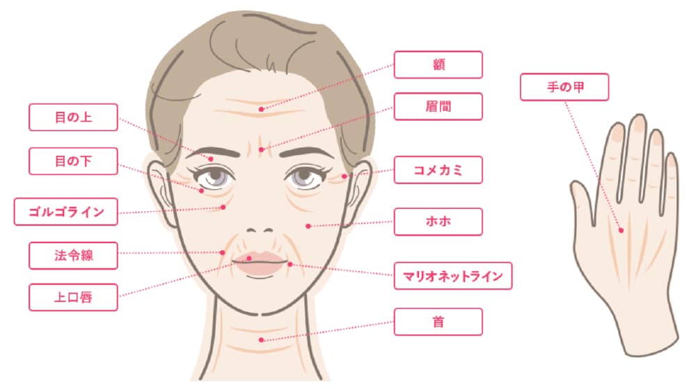 お顔と、手の甲に注入が可能です