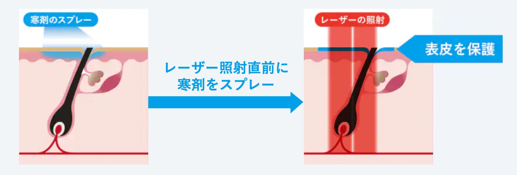 ２種類のクーリング機能で痛みの緩和