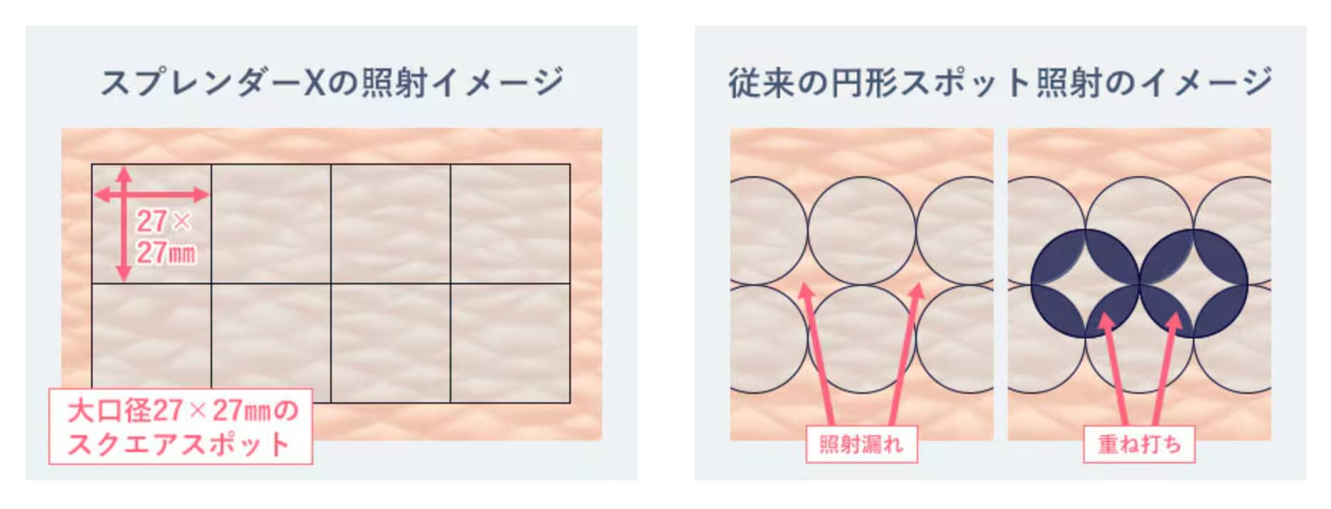 大きなスクエア照射で効率的に