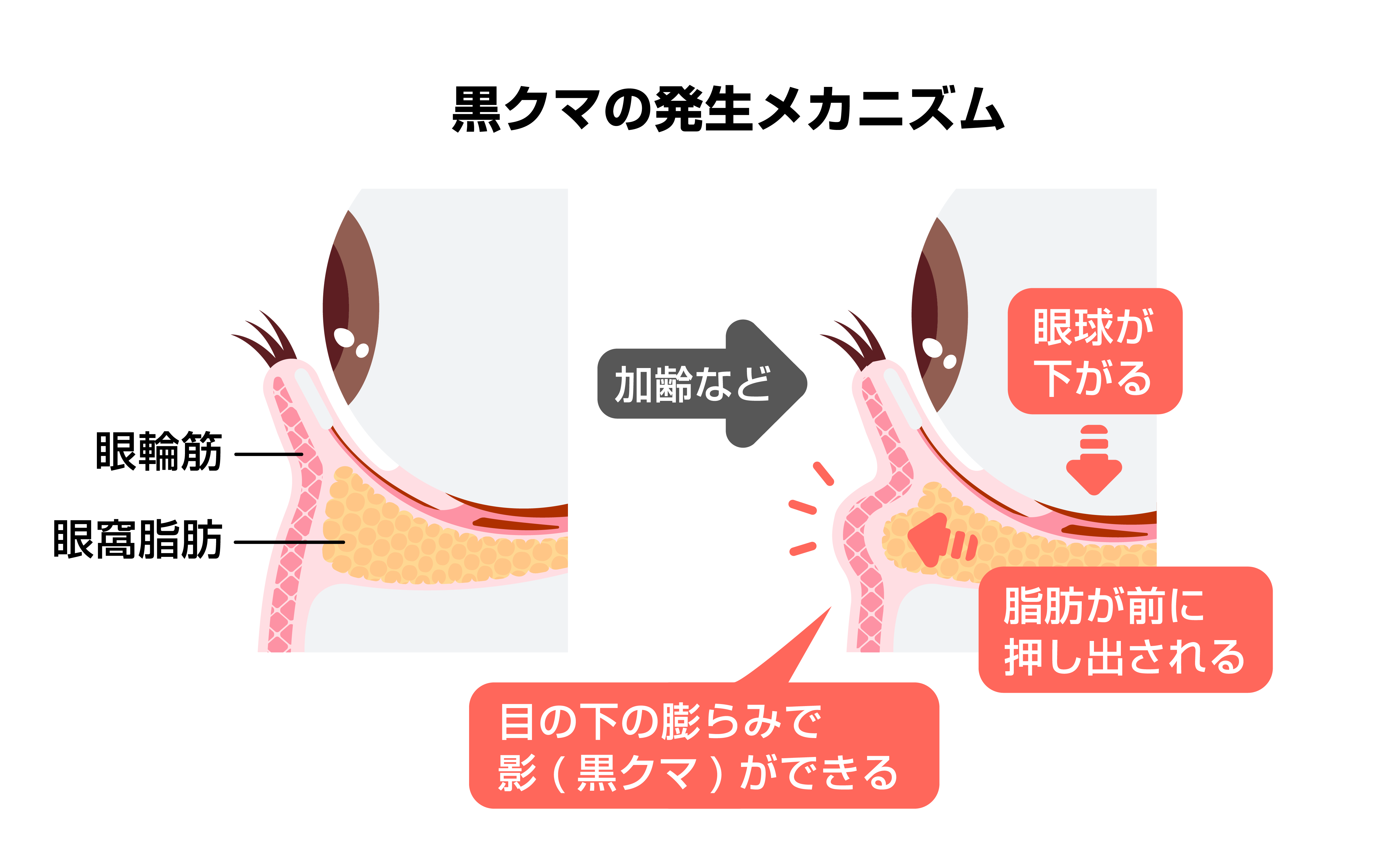 クマ？ふくらみ？それ脂肪です！