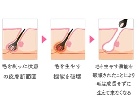 レーザー脱毛とは