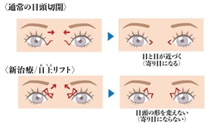 目上リフトが可能