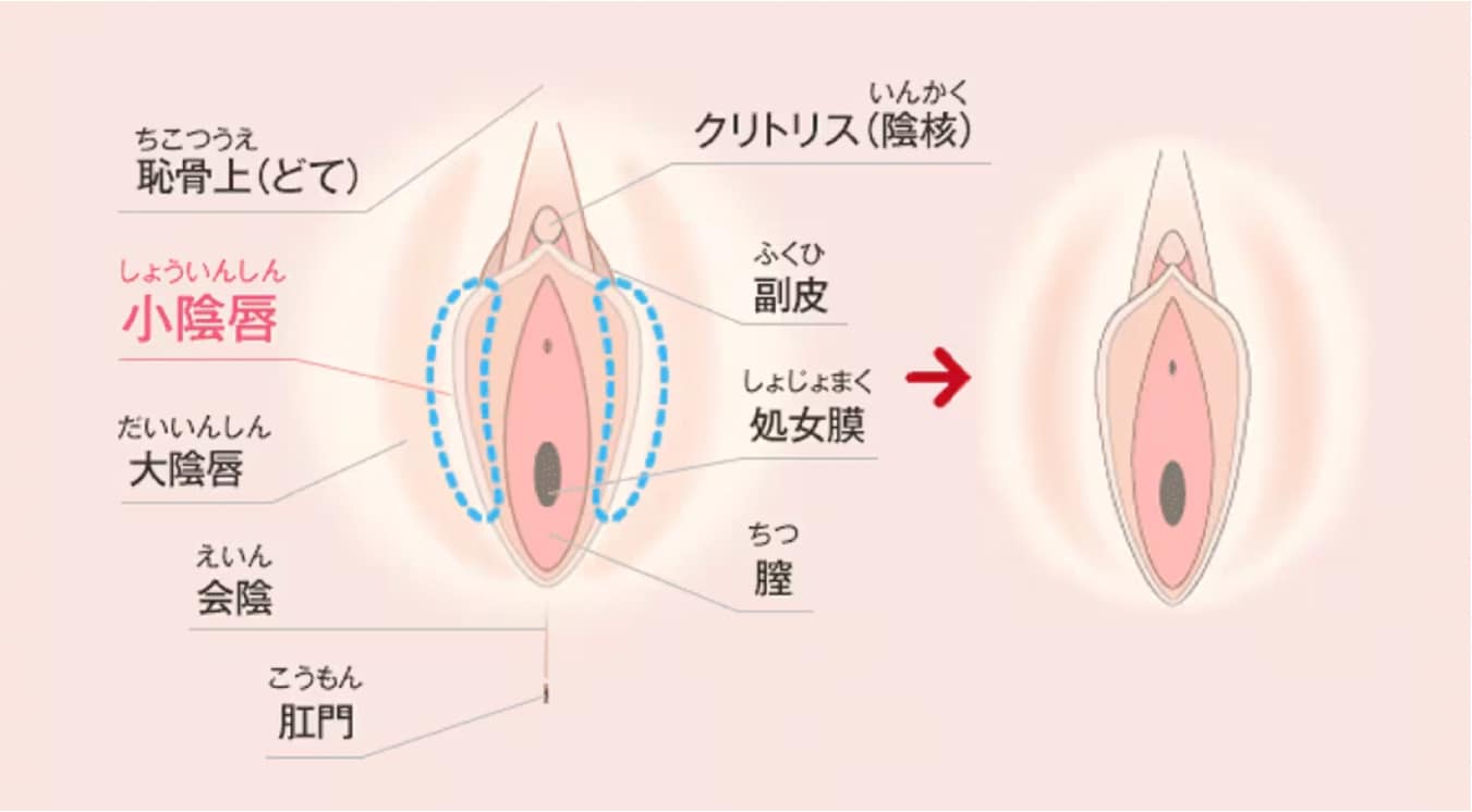 小陰唇縮小術