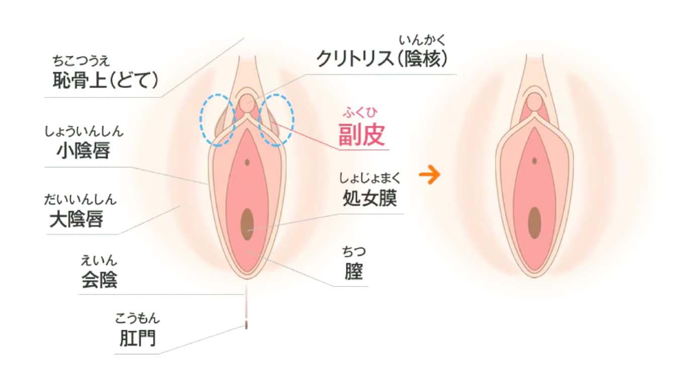 副皮除去術