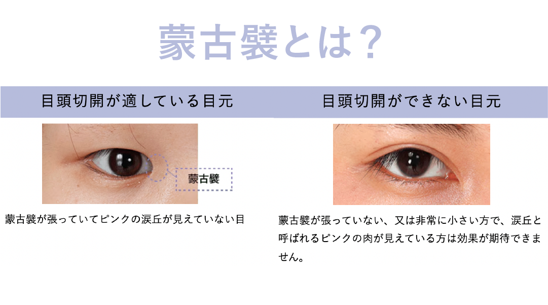 日本人に多い蒙古襞とは