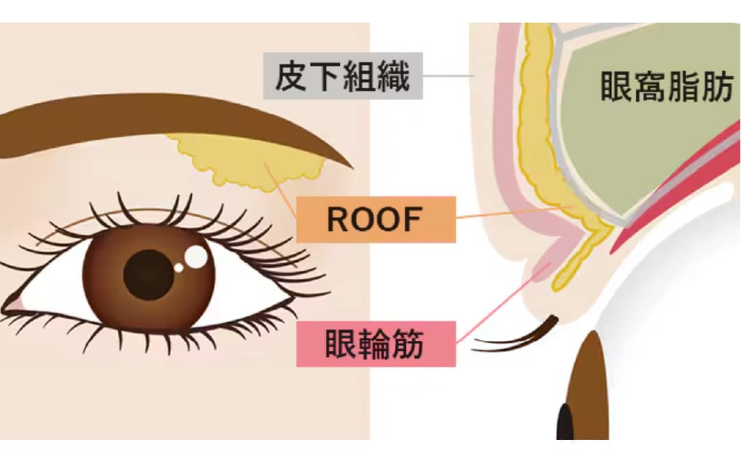 自然癒着セット(上眼瞼脱脂)とは