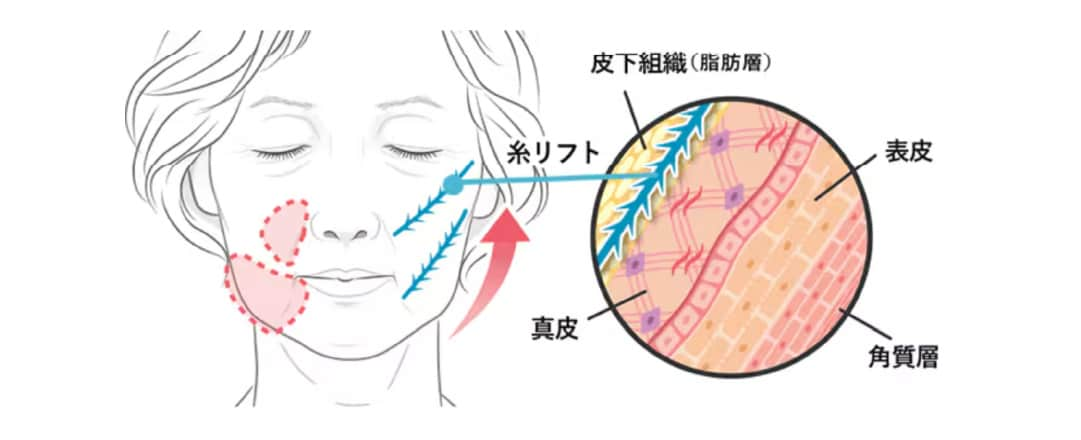 糸リフトの効果1