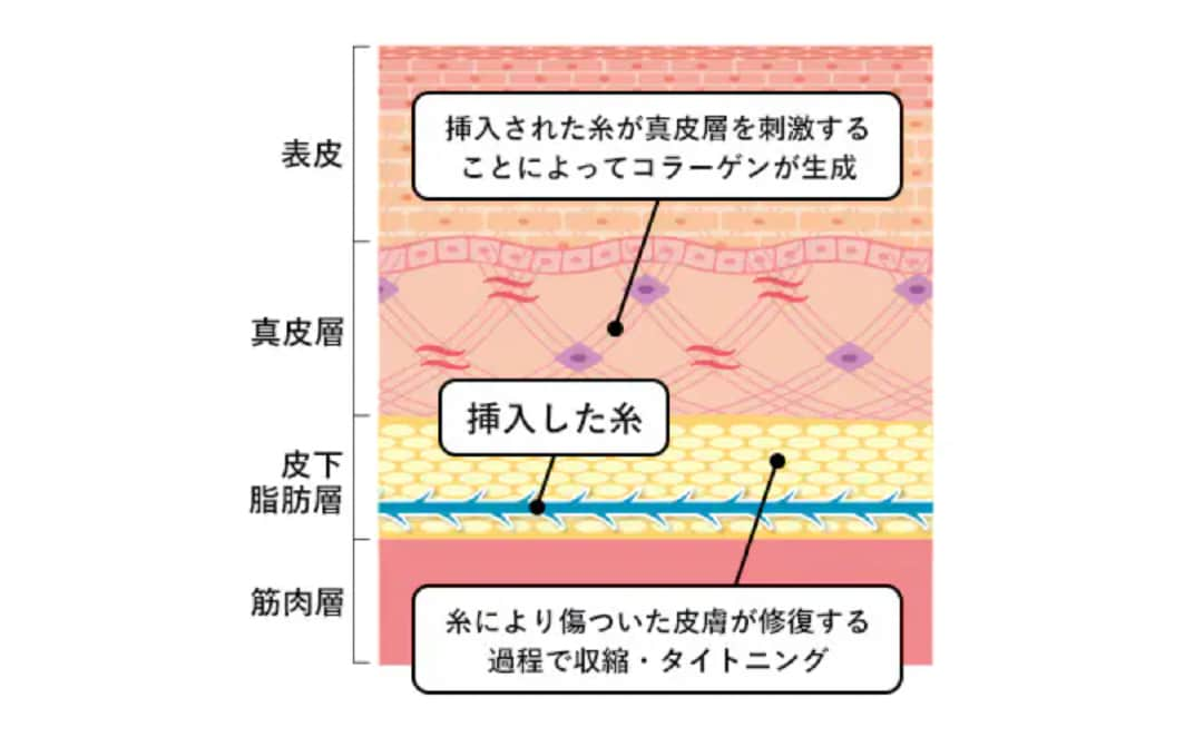 糸リフトの効果2